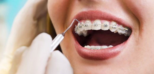 Veneers or Braces – Which One Gives the Most Effective Results