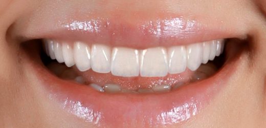 Informative Things One Should Know About Full Mouth Reconstruction
