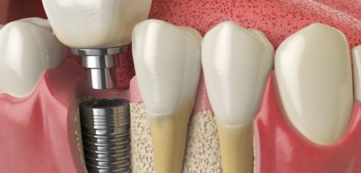 Cosmetic Dentistry: Should you Get Dental Implants?