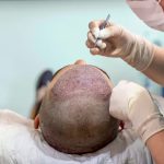 Reclaiming Your Crowning Glory: Success Stories of Hair Transplantation