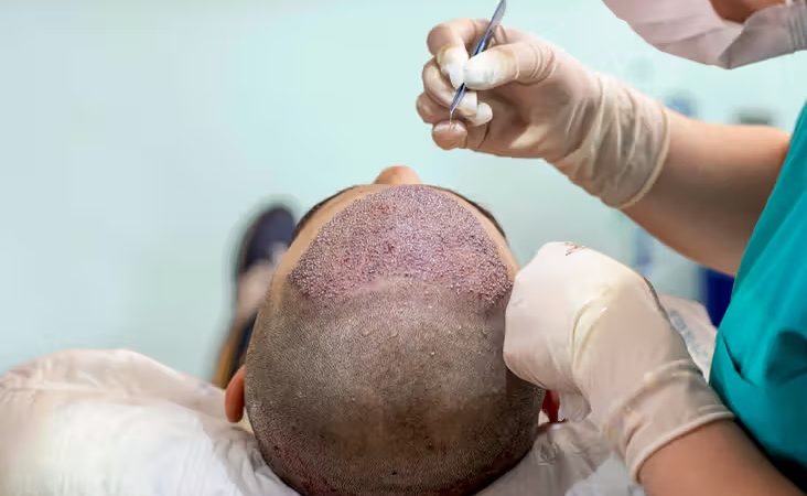 Reclaiming Your Crowning Glory: Success Stories of Hair Transplantation