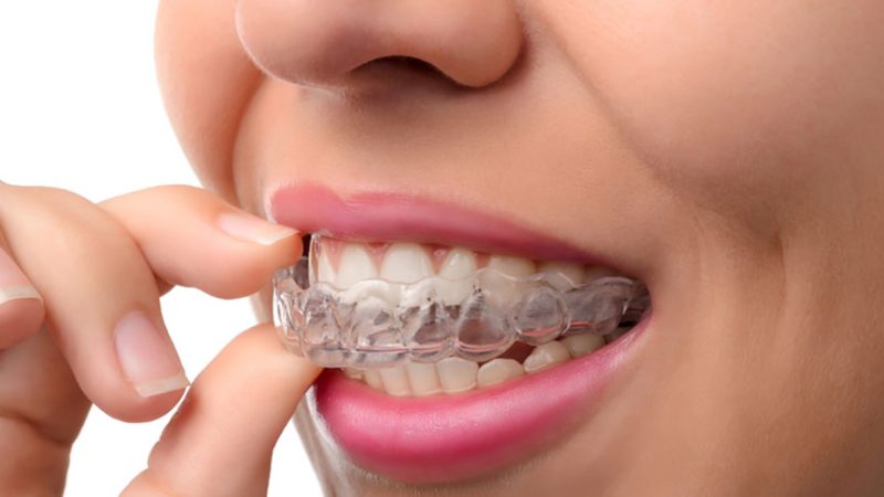 Invisalign treatment in Cary: What to expect?